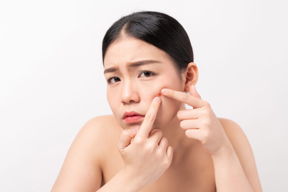 treat-acne-prone-skin